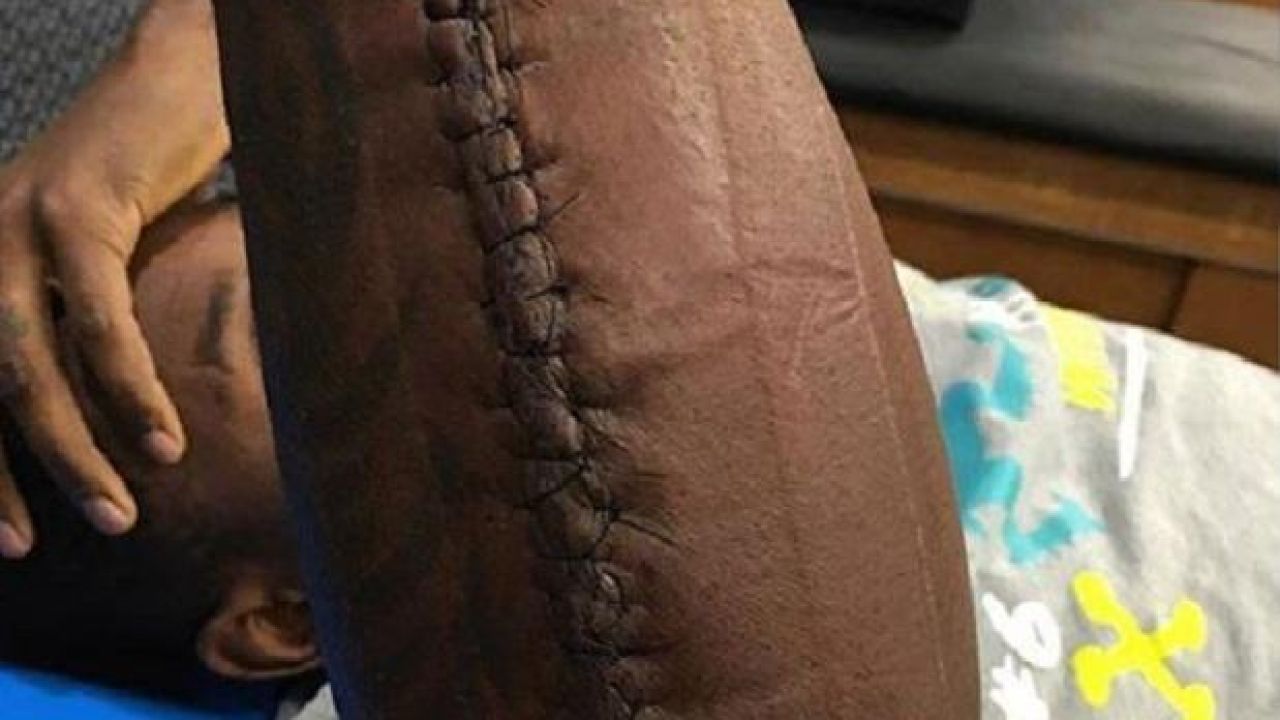 Panthers Tough-Nut Thomas Davis Played Super Bowl With This Gnarly Injury