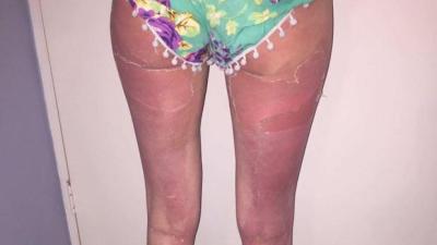 Banana Boat Responds To Claims The Sunscreen Is Getting Ppl Fucked-Up Burnt