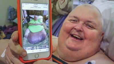 Bloke Who Was Told He Was “Just Fat” Actually Had A 60kg Tumour