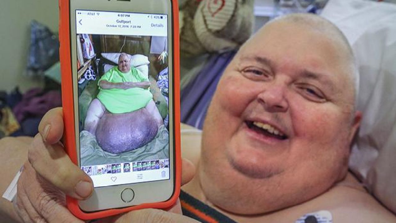 Bloke Who Was Told He Was “Just Fat” Actually Had A 60kg Tumour