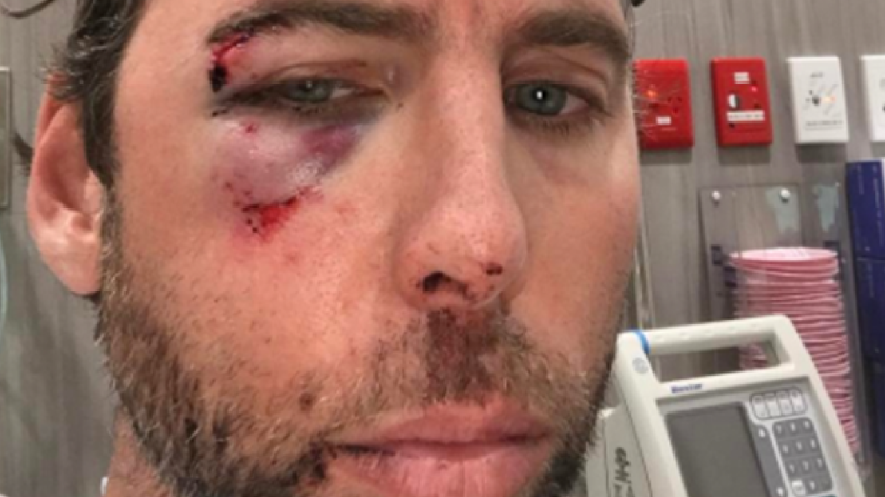 Grant Hackett Posts Pic Of Bloodied Face, Claims His Brother Beat Him Up