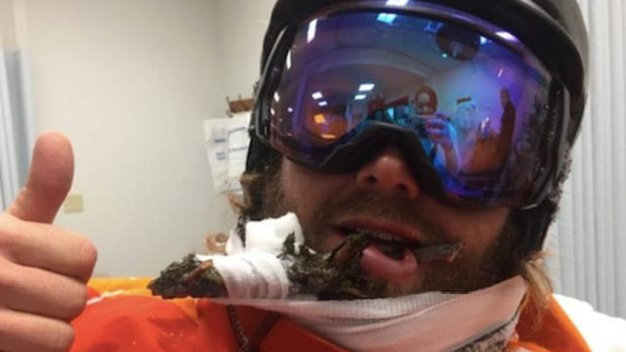 Absurdly Chill Ski Dude Crowdfunds Surgery To Remove Branch From His Gob