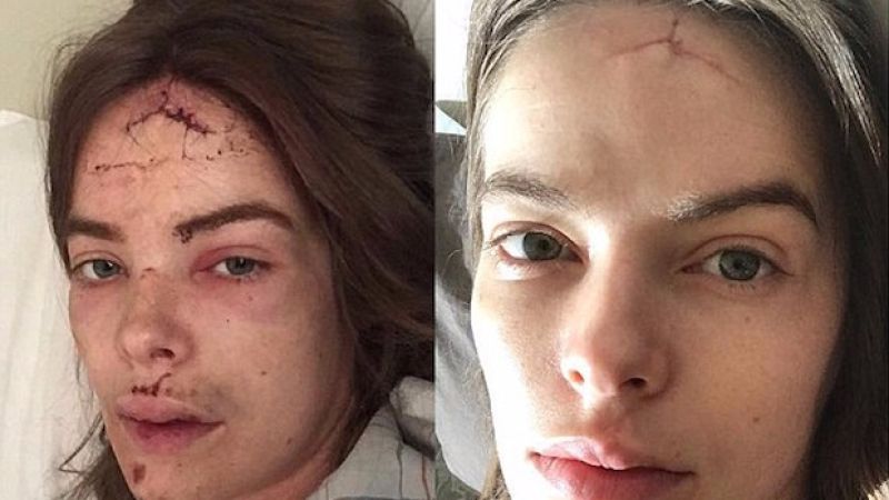 Robyn Lawley Gets Candid About Lupus Battle After Horrific Fall From Seizure