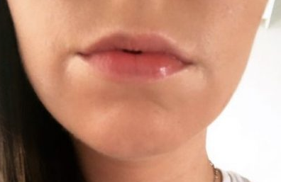 What Is The ‘Lip Flip’ & Why Are People Choosing It Over Lip Filler?