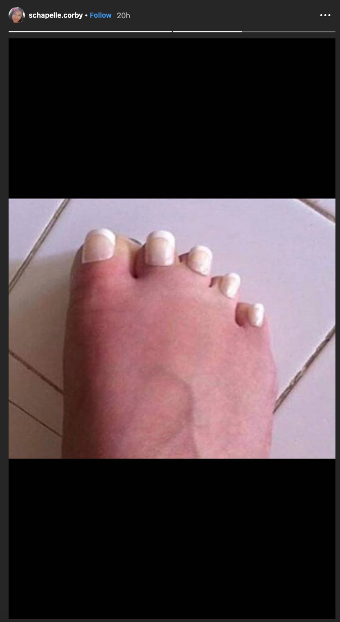 We Regret To Inform You Schapelle Corby Is Posting Crook Foot Content On IG Again