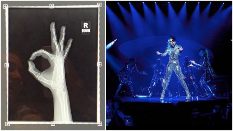 Lady Gaga Escapes Stage Fall Relatively Unscathed After Getting X-Rays On Most Of Her Body