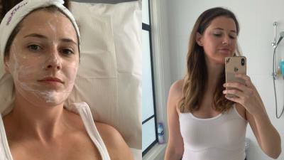 I Tried A Gentle Laser Treatment For Brighter Skin & After A ‘Sunburn’ Phase It Went Alright