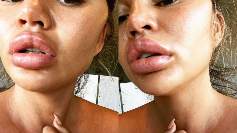 The Sun Is Shining, The Tank Is Clean And CHRIST Chrissy Teigen’s Lips Have Gone Nuclear
