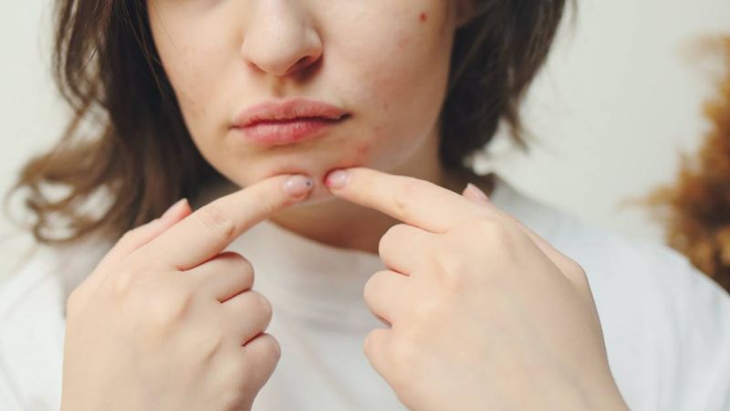 Humble Opinions: These Pimple Patches Will Actually Nix That Zit
