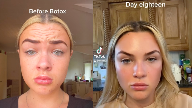 Young Aussies Are Taking To TikTok To Share Their ‘Baby Botox’ Preventative Wrinkle Treatments
