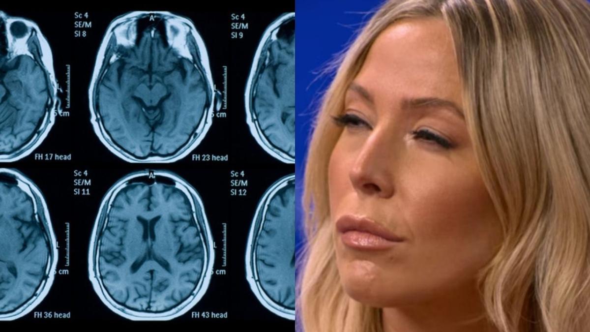 A woman squinting at brain scans. A new study shows COVID can shrink your brain matter.