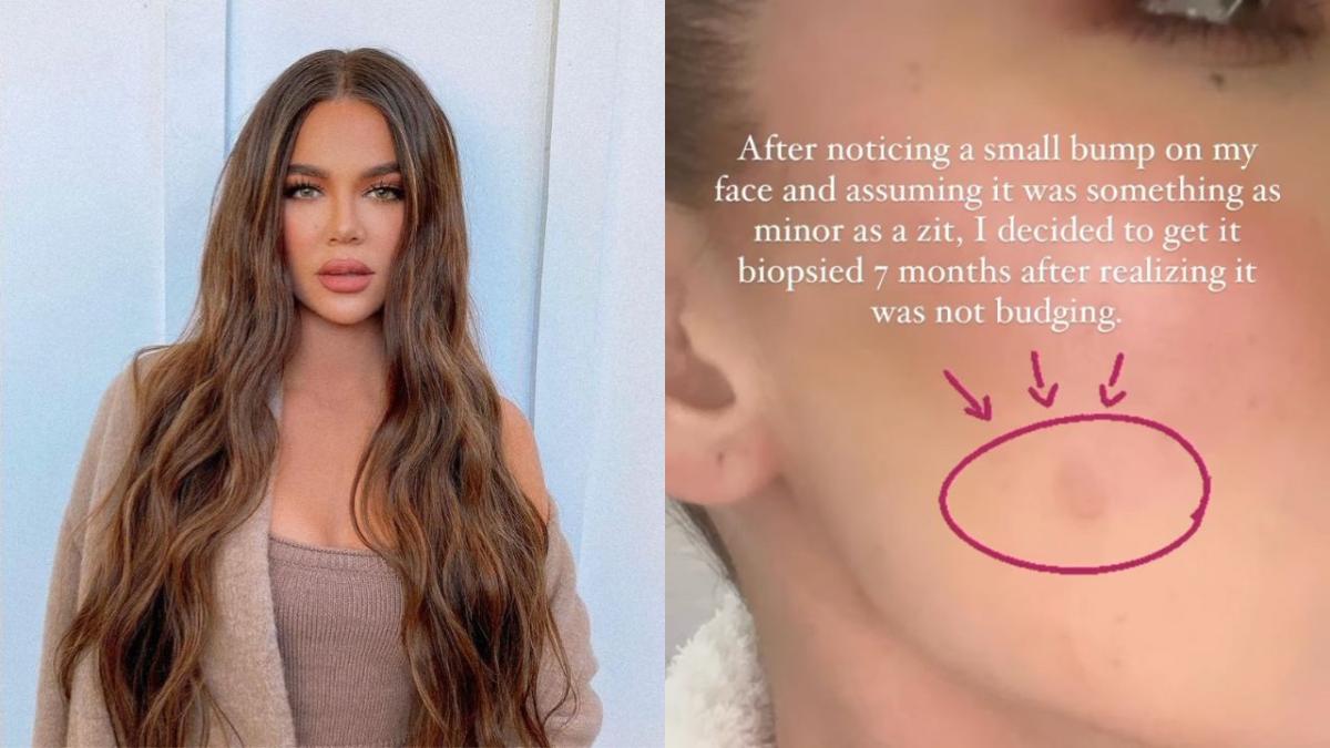 Khloe Kardashian reveals the reason she had a face bandage: she had to get a facial tumour removed bc of a risk of skin cancer