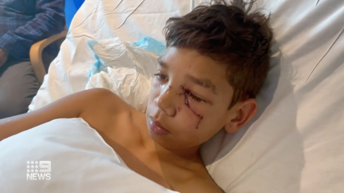 13-year-old Indigenous boy Jayden Abraham lies in hospital bed with stitches to his face after he was mauled by a police dog in Perth.